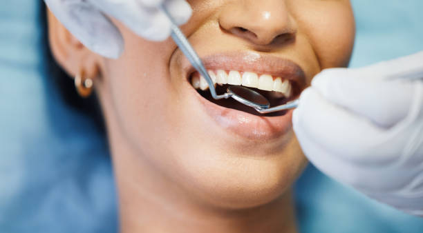 Best Knocked-Out Tooth (Avulsed Tooth) Treatment in Hollis, OK